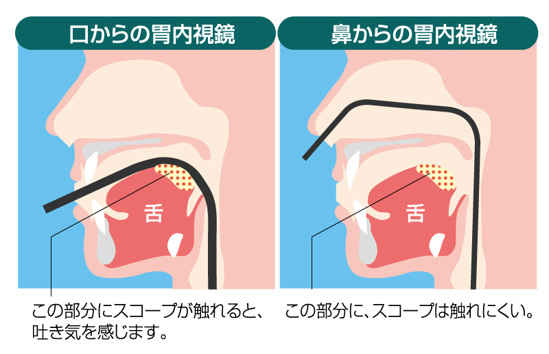 経鼻内視鏡１